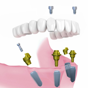 Имплантационные системы